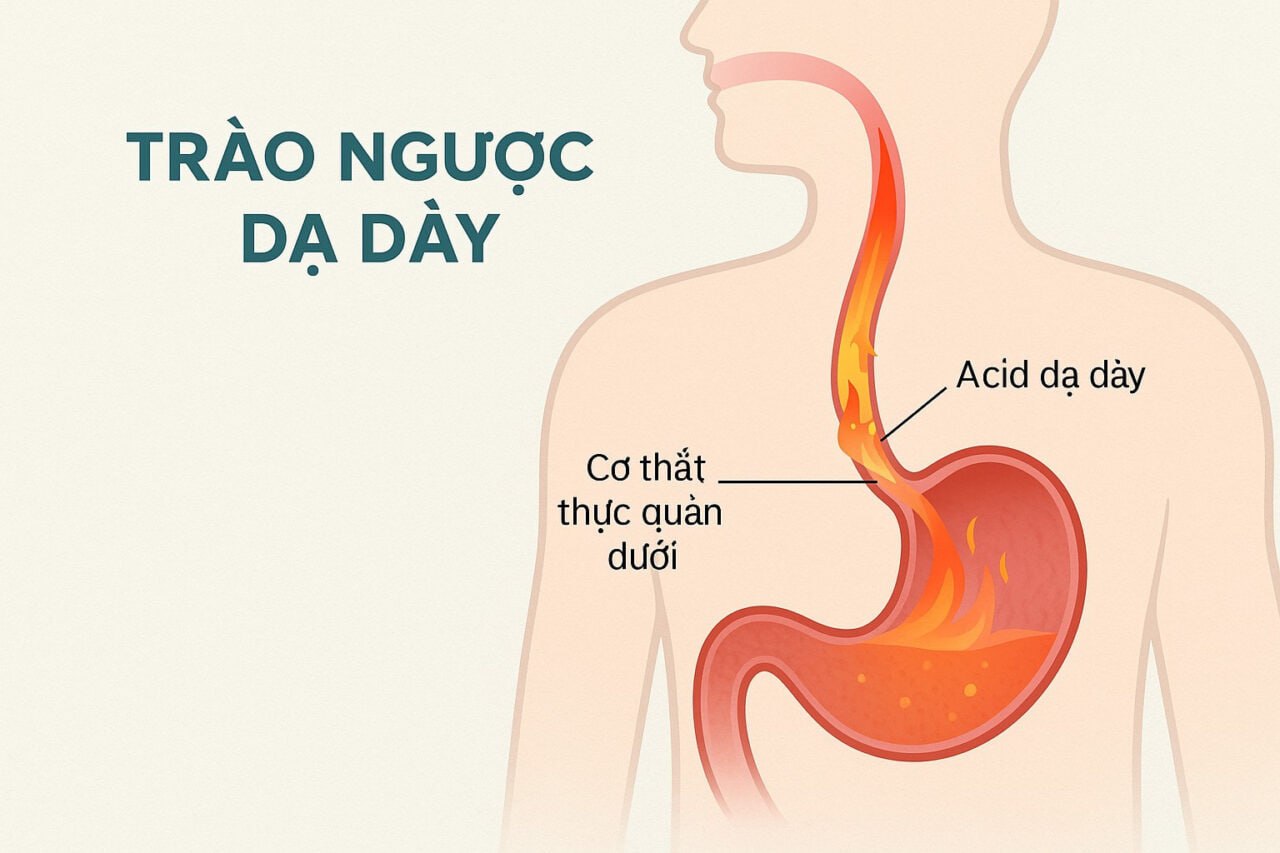 Trào ngược dạ dày - minh họa