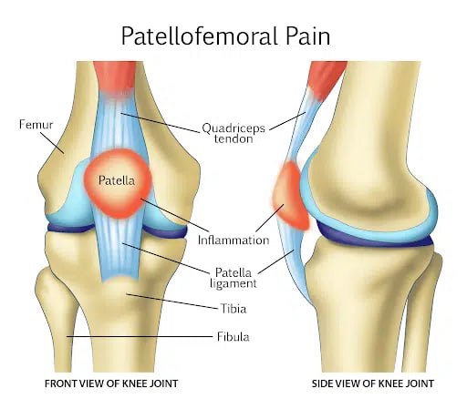 Hội chứng bánh chè - xương đùi (Patellofemoral Pain Syndrome): Nguyên nhân, triệu chứng và cách phục hồi