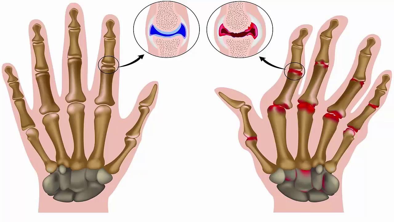 Biểu hiện của viêm khớp dạng thấp ở bàn tay